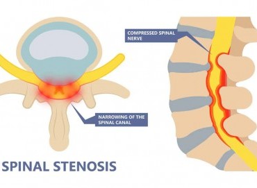 NARROWING OF THE SPINAL CANAL