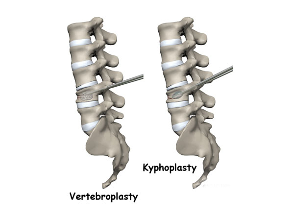 Kifoplasti - Vertebroplasti Nedir?