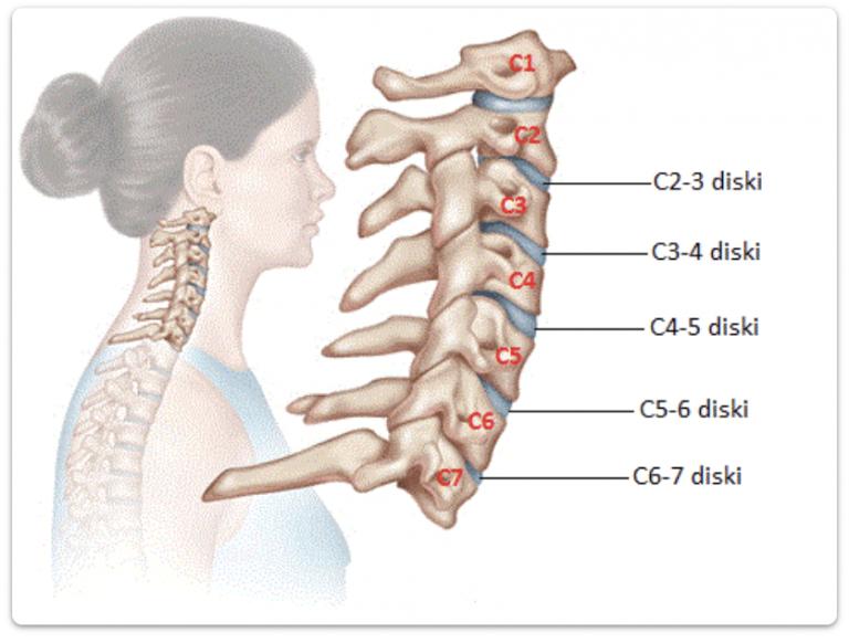 Mikrocerrahi İle Boyun Fıtığı Tedavisi